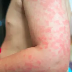 Czerwona, swędząca wysypka na ramieniu i klatce piersiowej, objaw uczulenia po solarium.