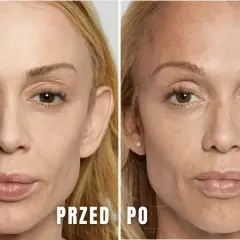 Przed i po zabiegu z kwasami na twarz. Zauważalne zmiany w teksturze skóry, redukcja przebarwień i drobnych zmarszczek. Brak widocznych efektów ubocznych.