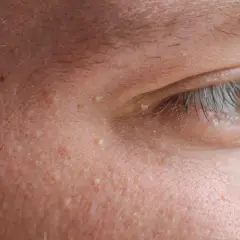 Widoczne drobne prosaki na powiece. Szukasz domowych sposobów na ich usunięcie?