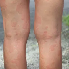 Nogi pokryte swędzącymi bąblami, objaw pokrzywki alergicznej. Czas trwania może być różny.