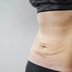 Skóra po schudnięciu 40 kg, z widocznymi rozstępami i przebarwieniami na brzuchu.