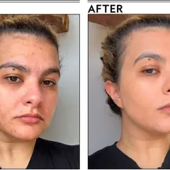 Przed i po: skóra z niedoskonałościami i zaczerwienieniami po zastosowaniu podkładu Tirtir Mask Fit Red Cushion, który wyrównał koloryt i ukrył zmiany.