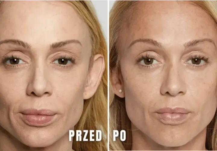 Przed i po zabiegu z kwasami na twarz. Zauważalne zmiany w teksturze skóry, redukcja przebarwień i drobnych zmarszczek. Brak widocznych efektów ubocznych.
