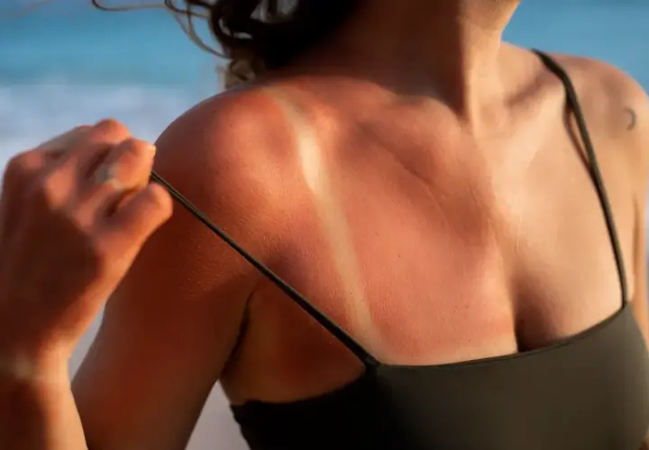 Oparzona skóra po opalaniu w solarium, z wyraźnymi śladami po ramiączkach kostiumu.