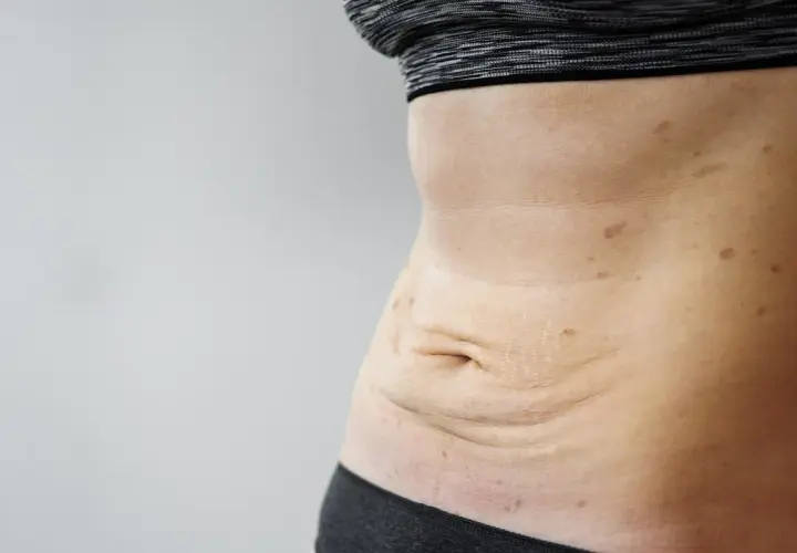 Skóra po schudnięciu 40 kg, z widocznymi rozstępami i przebarwieniami na brzuchu.