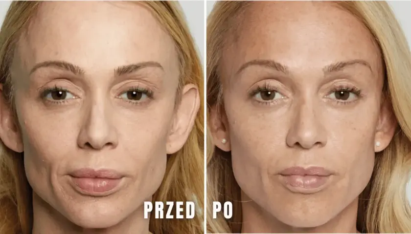 Przed i po zabiegu z kwasami na twarz. Zauważalne zmiany w teksturze skóry, redukcja przebarwień i drobnych zmarszczek. Brak widocznych efektów ubocznych.