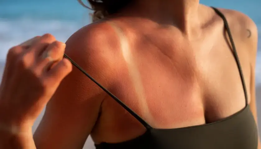Oparzona skóra po opalaniu w solarium, z wyraźnymi śladami po ramiączkach kostiumu.