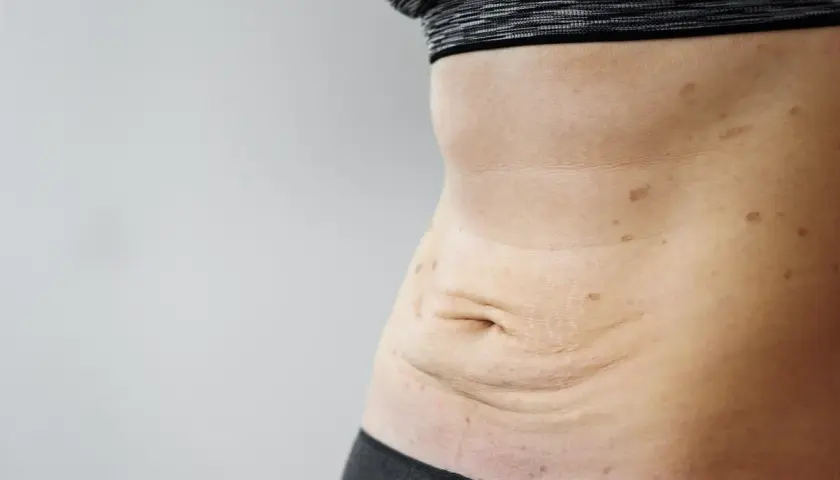 Skóra po schudnięciu 40 kg, z widocznymi rozstępami i przebarwieniami na brzuchu.
