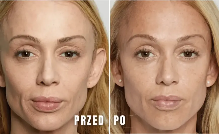 Kwasy na twarz - Kiedy są normalne reakcje, a kiedy problem?