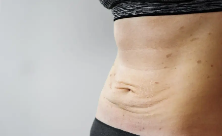 Skóra po schudnięciu 40 kg - Co działa, a co nie?