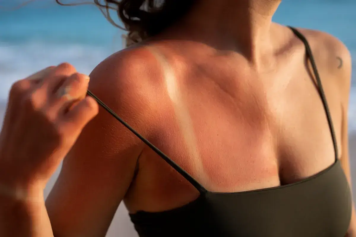 Oparzona skóra po opalaniu w solarium, z wyraźnymi śladami po ramiączkach kostiumu.