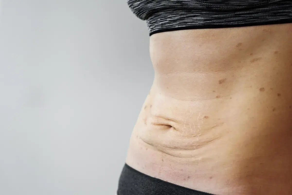 Skóra po schudnięciu 40 kg, z widocznymi rozstępami i przebarwieniami na brzuchu.