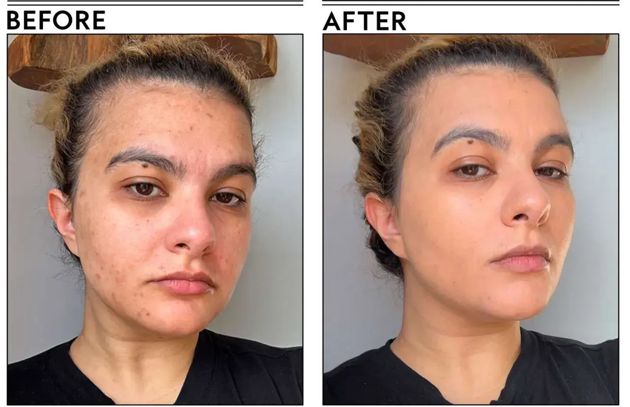 Przed i po: skóra z niedoskonałościami i zaczerwienieniami po zastosowaniu podkładu Tirtir Mask Fit Red Cushion, który wyrównał koloryt i ukrył zmiany.